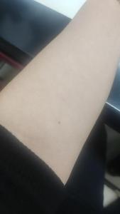 胳膊內側有痣
