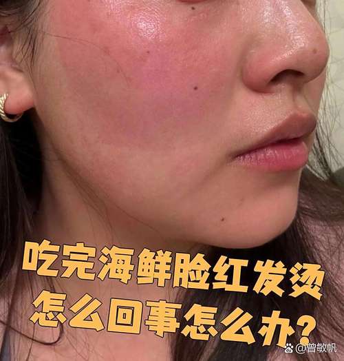 臉頰發燙是什么意味著