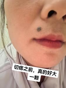 交界痣切除就沒事了嗎