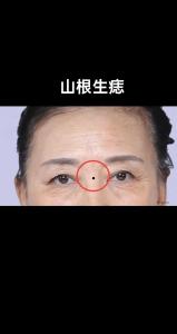 男人臉上哪些痣不好 山根上長有痣情感運勢不好