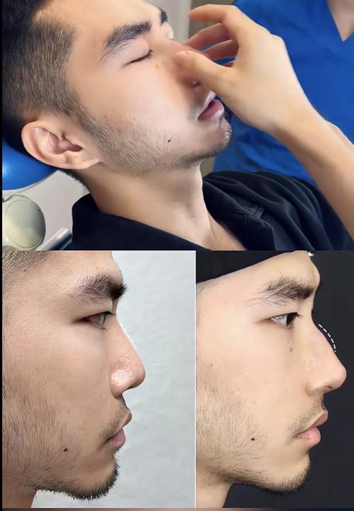 男人駝峰鼻能嫁嗎