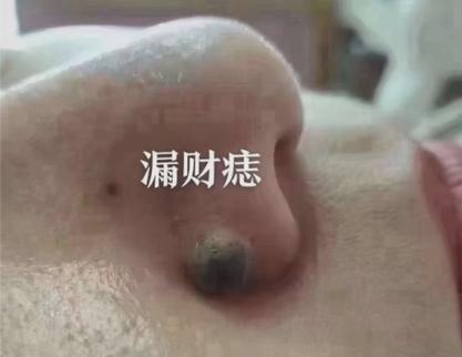 鼻翼有痣