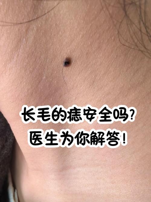 痣上長毛好不好,痣上長毛代表什么？