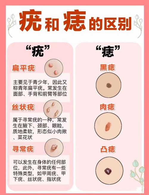 痦子是痣嗎 和痣的區(qū)別