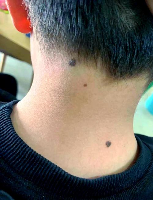 男人脖子前面有痣好不好
