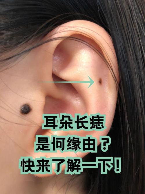 耳朵上有痣的男人犯雙親是真的嗎？