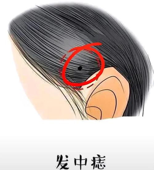 頭發中長痣，在什么位置最好？