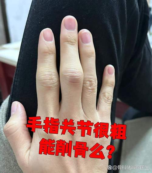 手指關節大的人就一生勞苦嗎?