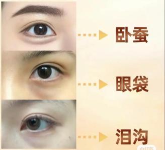 臥蟬和眼袋有什么區別