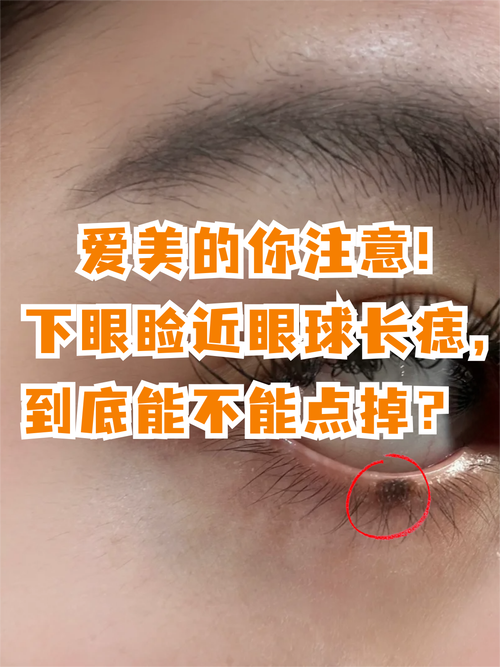 右眼下眼皮有痣 左眼有痣好還是右眼有痣好