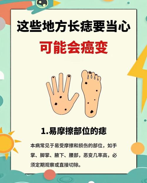這四處痣會給你帶來大麻煩！需注意！