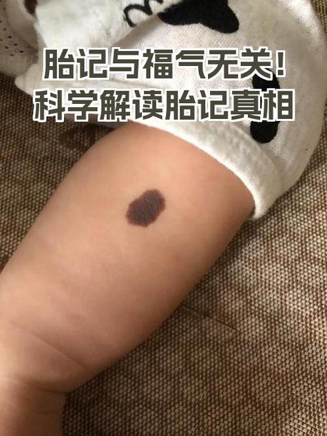 腿上胎記預(yù)示著什么