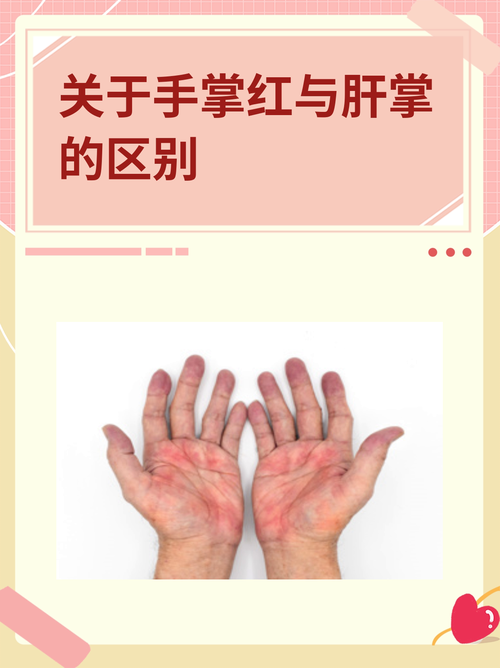 朱砂掌手相特征 朱砂掌與肝掌的區(qū)別是什么