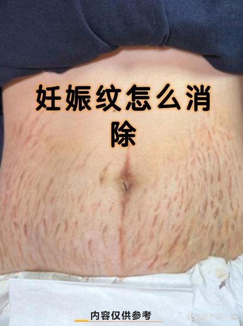 妊娠線會自己消失嗎