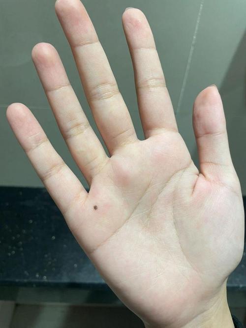 女人左手掌心突然長痣 主富貴且聰慧
