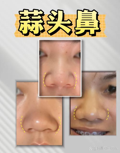 蒜頭鼻長什么樣,什么是蒜頭鼻