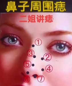 鼻子左側的痣能點嗎,鼻子上有痣可以點嗎