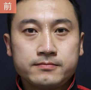 鼻子歪斜的男人面相 婚姻靠不住