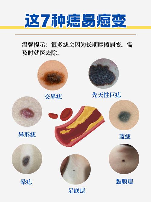 痣是天生的嗎