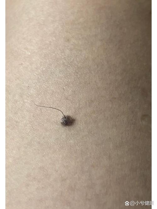 為什么痣上會長毛