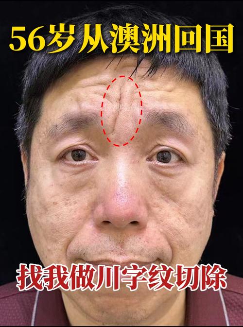 男人額頭二道橫紋 注意心情平和