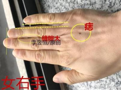 男人右手背長痣如何