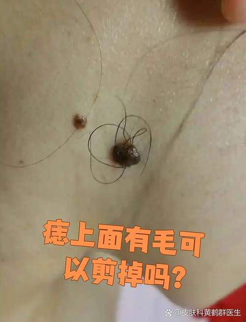 痣上長(zhǎng)毛是富貴痣嗎
