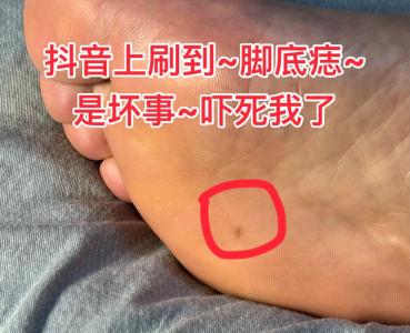 女人腳底有痣好不好？
