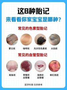 胎記的位置與命運