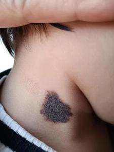 脖子上有胎記的命運