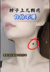 長在脖子上的痣是好是壞?