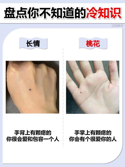 女人手背有痣好不好
