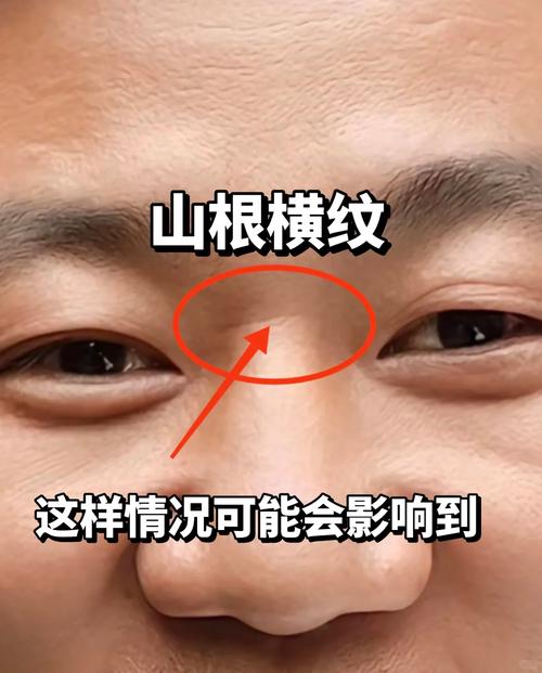 鼻梁山根有橫紋代表什么 富貴難尋家中散財(cái)
