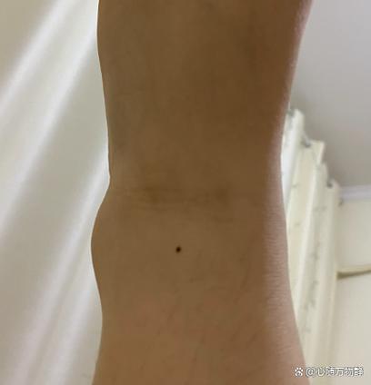 女人左腳踝有痣