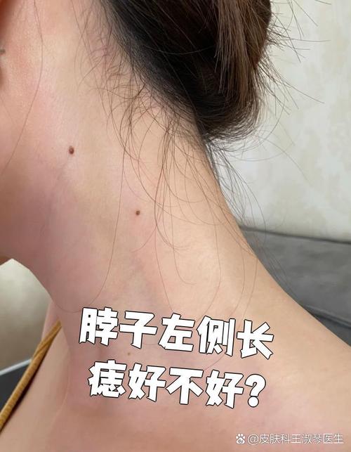 左脖子有痣的女人