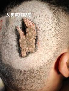 頭上長肉痣代表什么
