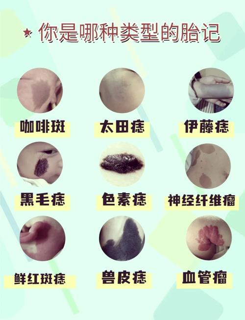 胎記長在什么地方好，體相中胎記詳細分析