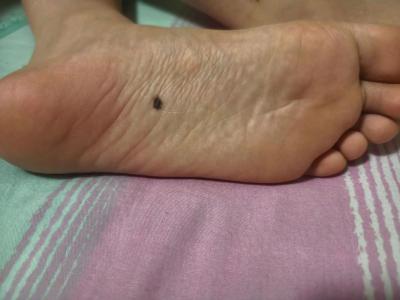 小男孩左腳腳底長痣好不好