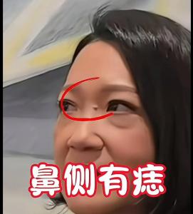 山根有痣需要點掉嗎