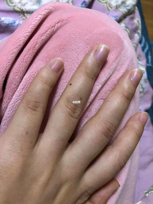 女左手無名指側(cè)面有痣