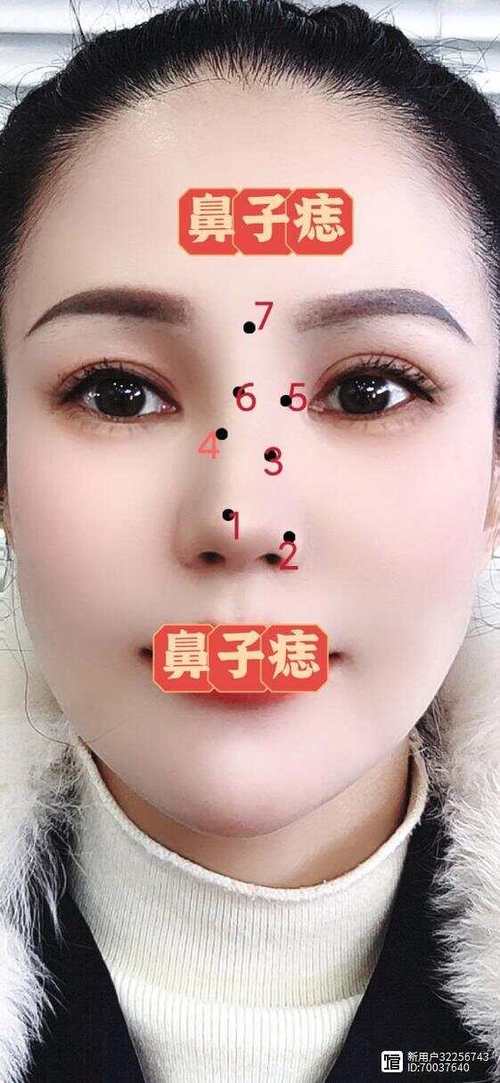 鼻孔邊長痣